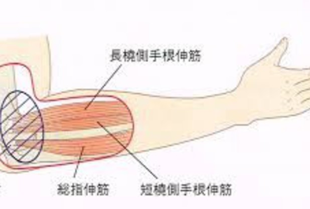 テニスエルボー（テニス肘）