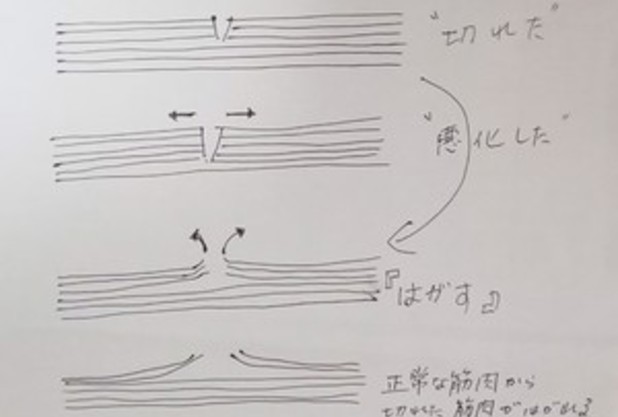 『肉離れ』についての体験談