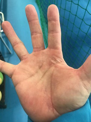 手の豆 ブログ ユニバーサルテニススクール河内長野 テニススクール 関東 関西を中心にテニス関連事業を展開する会社テニスユニバース